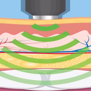 Penile ESWT Training Course