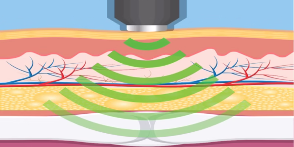 Penile ESWT Training Course
